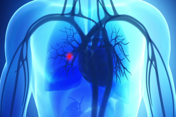 Best Pulmonology Hospital in Bhilai